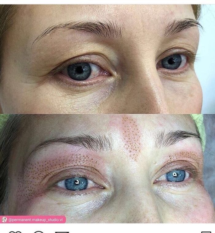 Plasma lift utbildning - Bild 2